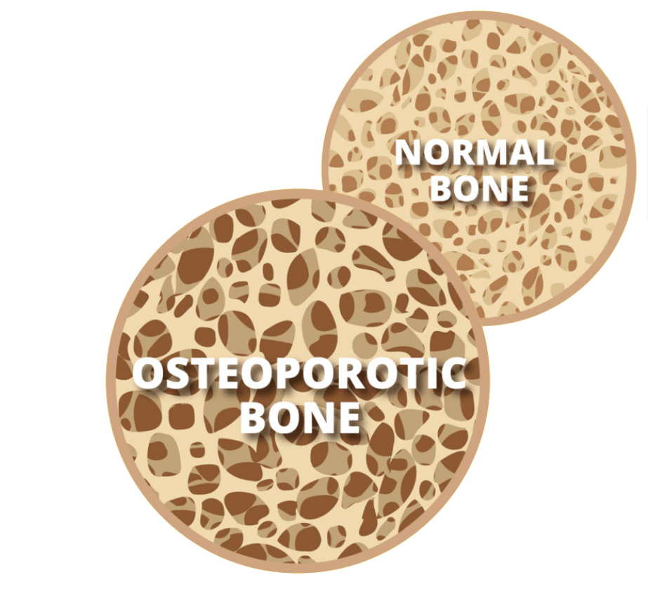 Bone Health Illustration