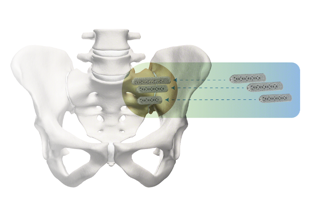 3d-implants-into-pelvis